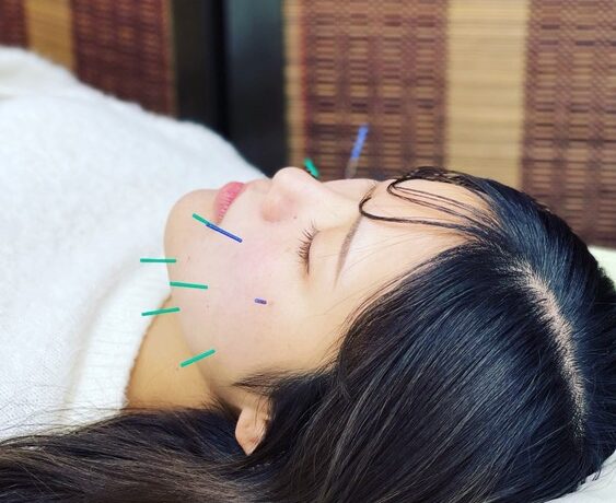 美容鍼　松本接骨院・はり灸院